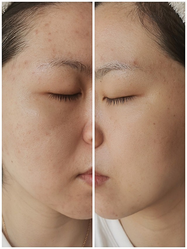 可丽金美塑微针,皮肤补水站.