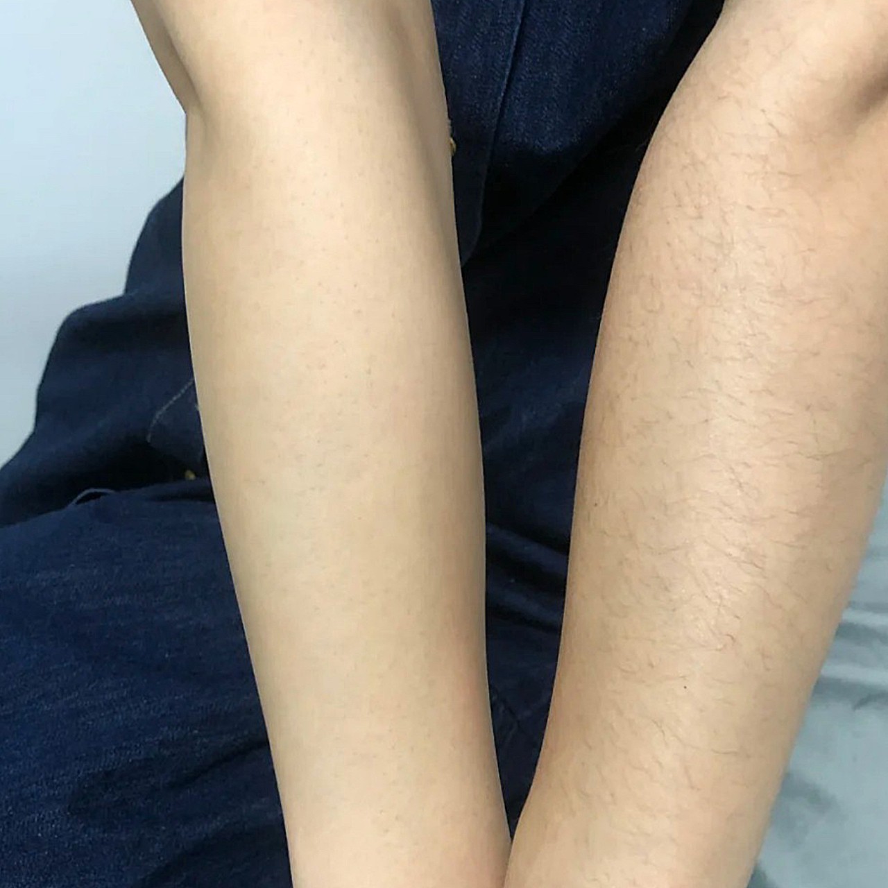 体验前变美诉求:手臂上的汗毛很重,特别影响穿衣服的美感,想脱掉汗毛.