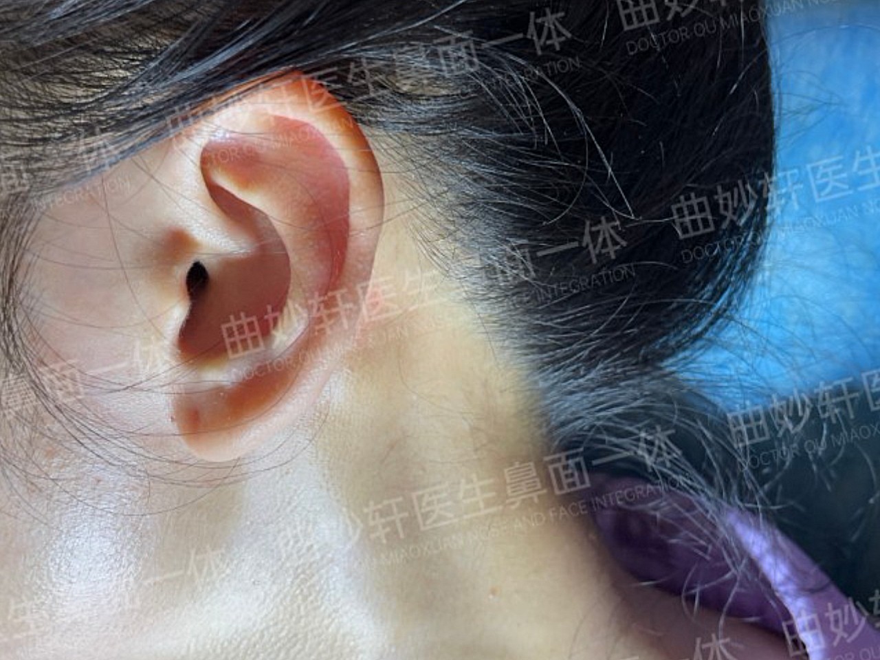 取耳软骨设计在耳后比较隐蔽,疤痕社交距离看不见,仔细拉起耳朵看,能