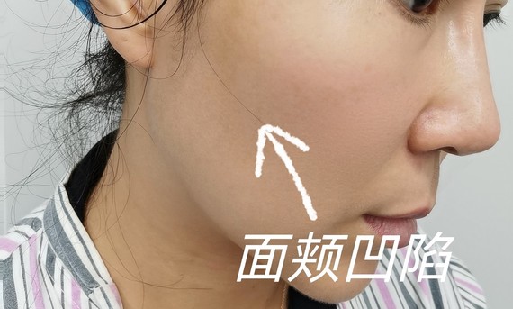 010101脸颊凹陷是很_圈子-新氧美容整形