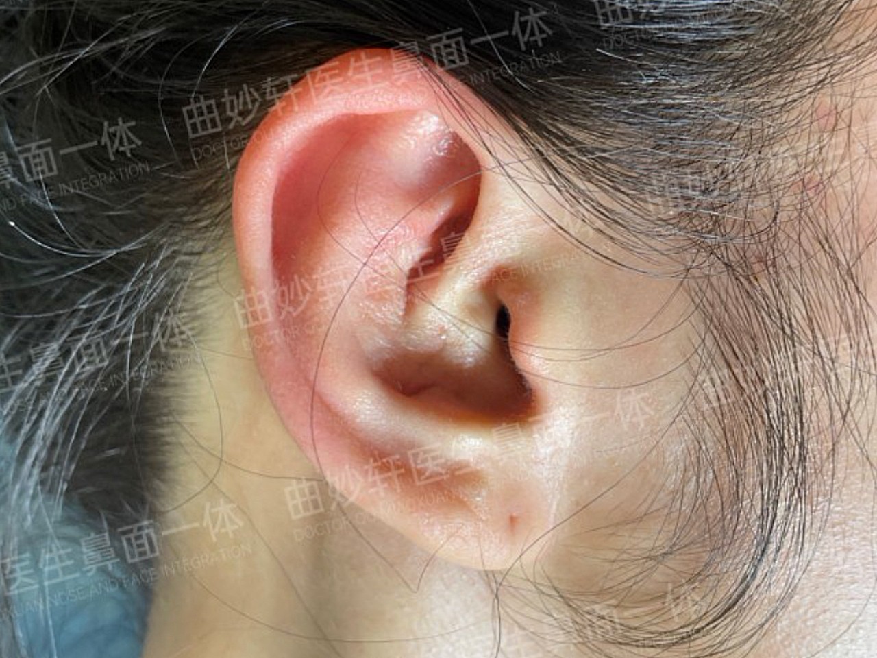 取耳软骨设计在耳后比较隐蔽,疤痕社交距离看不见,仔细拉起耳朵看,能