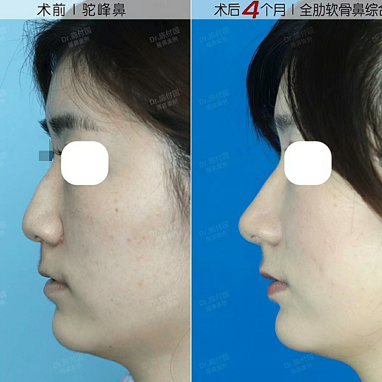 初鼻大鼻头鼻小柱内缩