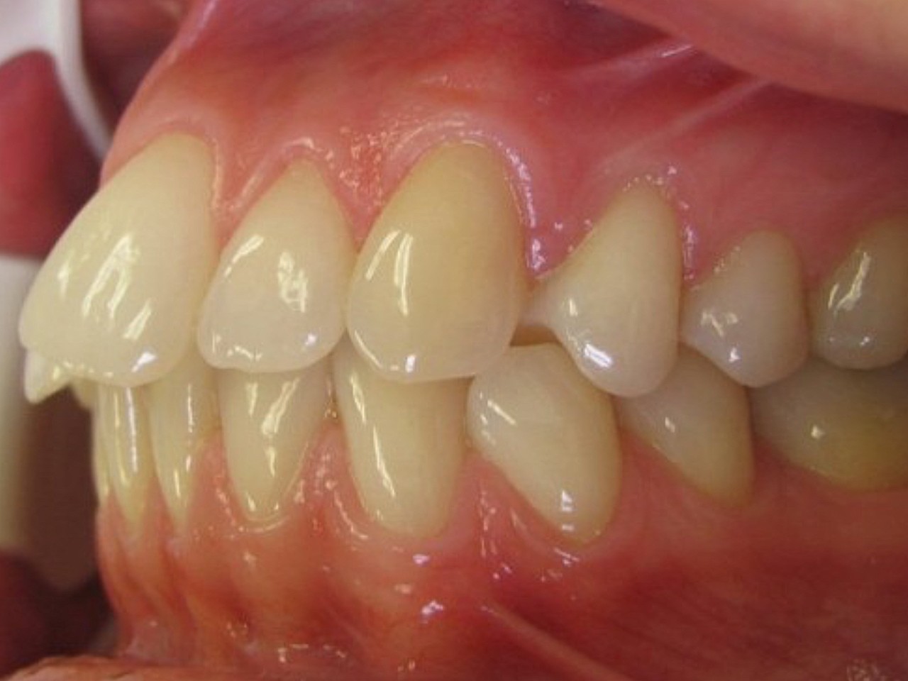 术前诊断牙齿矫正姑娘牙齿深覆合深覆盖,上下牙弓狭窄_圈子-新氧美容