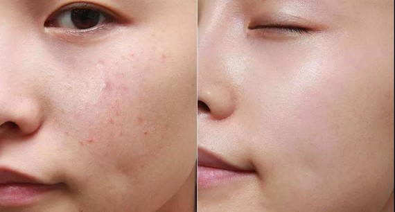 刷酸以前叫果酸换肤原理就是通过酸性凝胶腐蚀掉皮肤表面的角质层加速