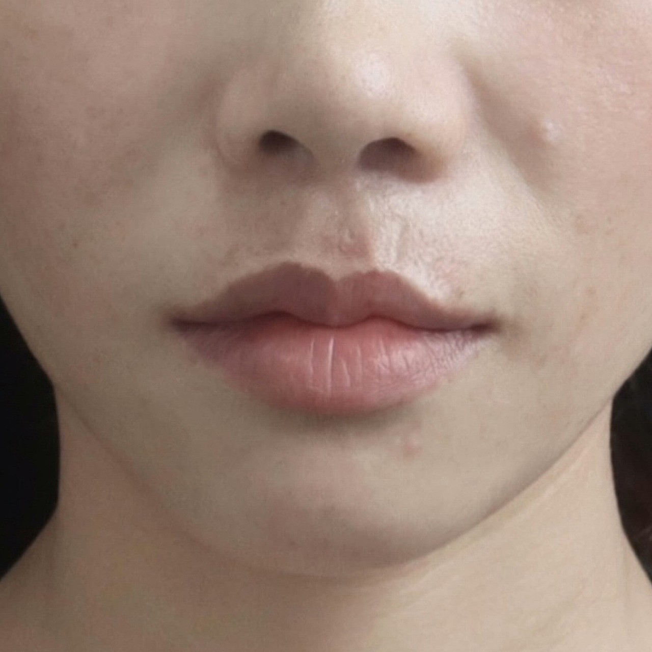 术前诊断该求美者术前人中窝平坦且较宽,整个面部看起_圈子-新氧美容