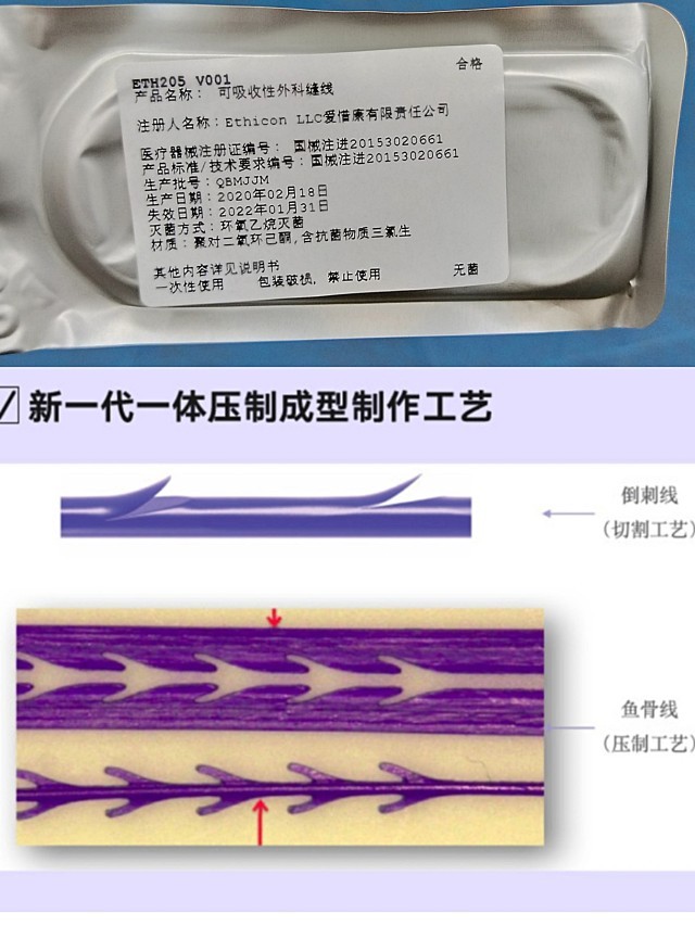 93关于强生鱼骨线的体验过程92前期恢复的情况90以及各_圈子