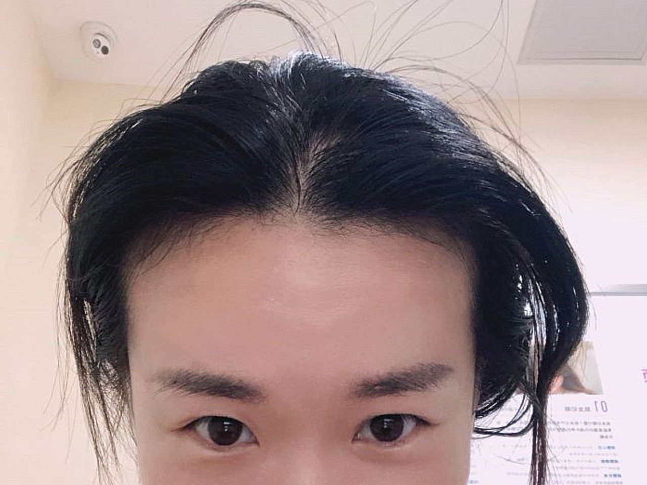 体验前变美诉求:我的额头天生又大又宽,想做个植发,美化一下发际线,让