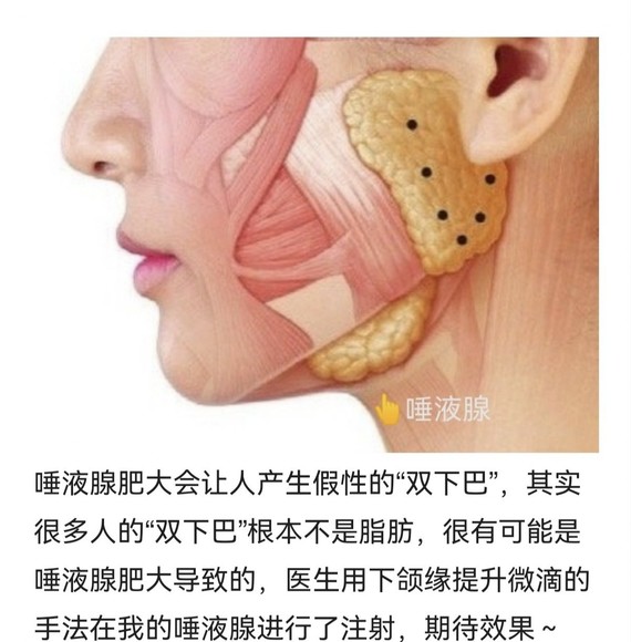 肉毒收紧下颌缘示意图图片