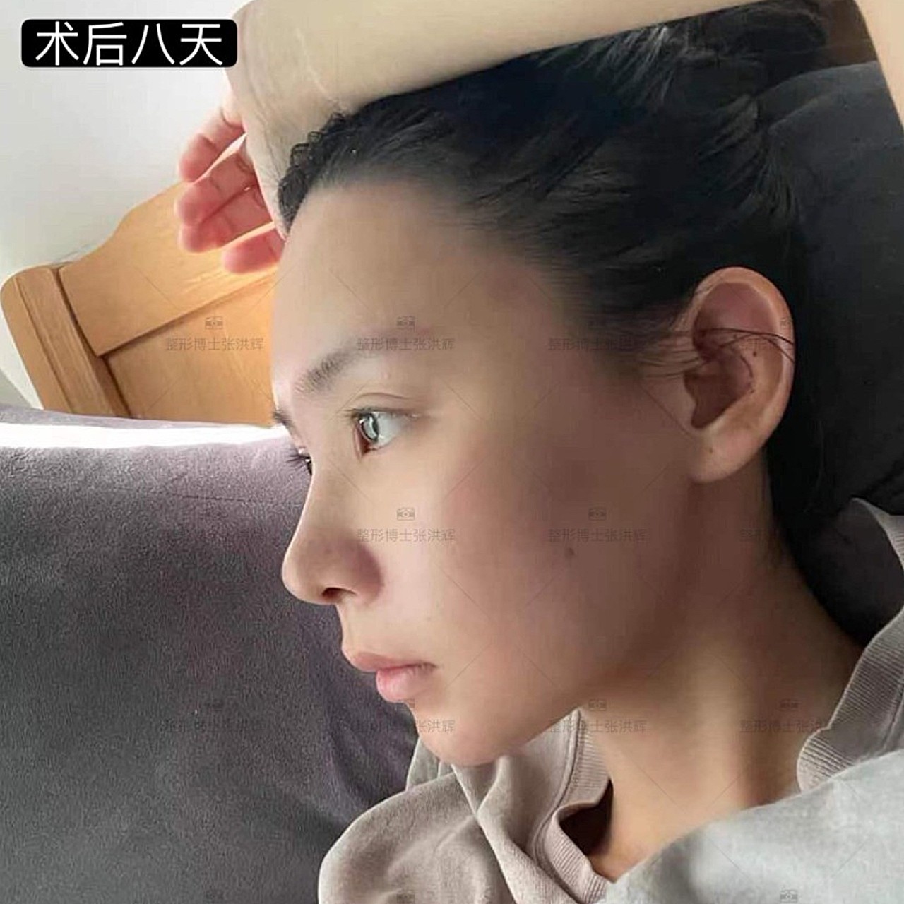 术前诊断张洪辉医生-鼻部案例##双侧耳软骨隆鼻#77_圈子-新氧美容