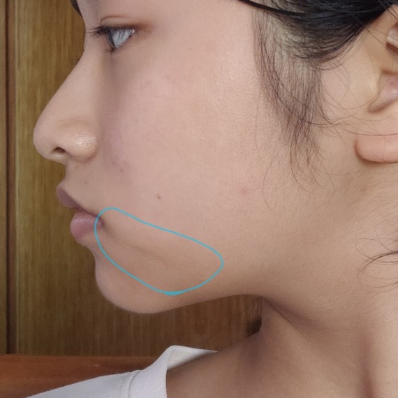 脸颊下垂,显老不上镜,还有几乎看不到的下颌线00没有_圈子-新氧美容