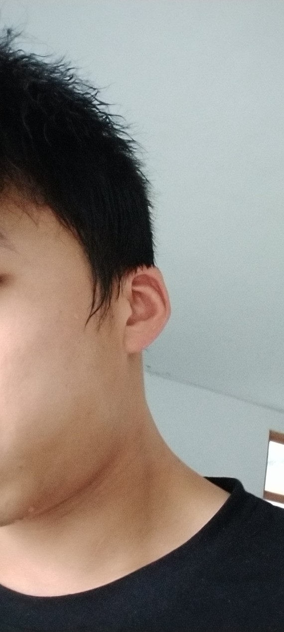 耳朵轮廓可以变大么