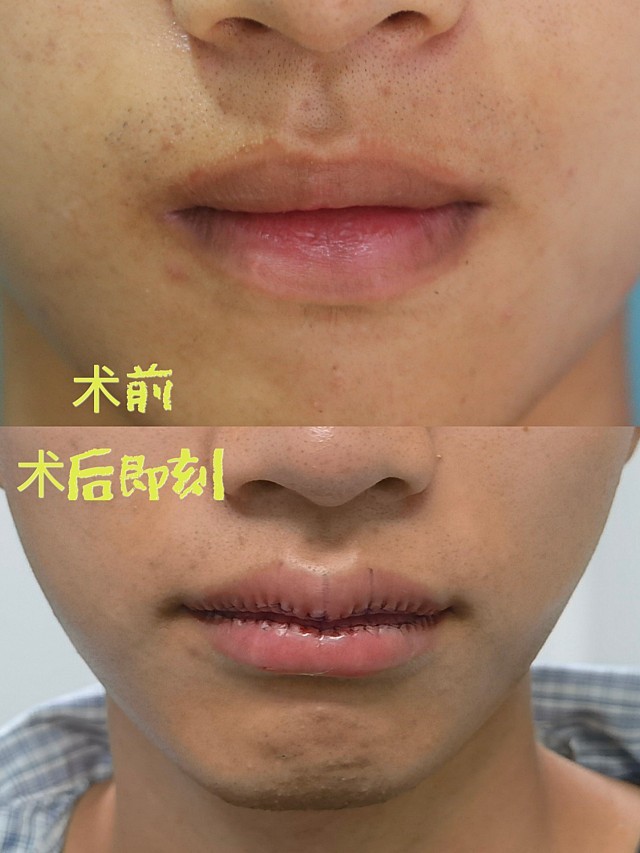 体验前变美诉求:嘴巴有些许不对称,轮廓感也不是很强,作为男生,还是