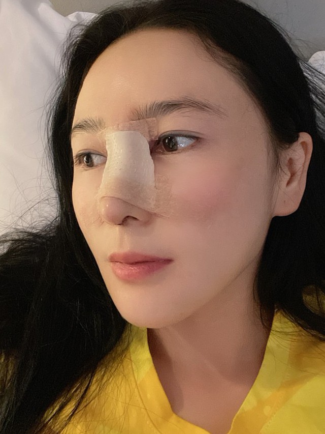 鼻子现在还包着纱布,好期待过几天拆了现的样子,现在_圈子-新氧美容
