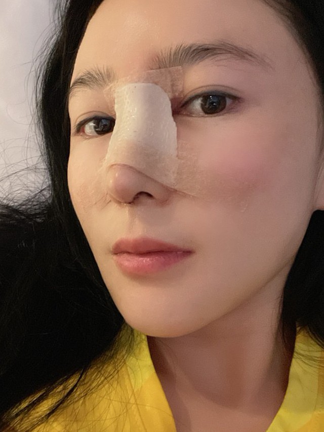 鼻子现在还包着纱布,好期待过几天拆了现的样子,现在_圈子-新氧美容