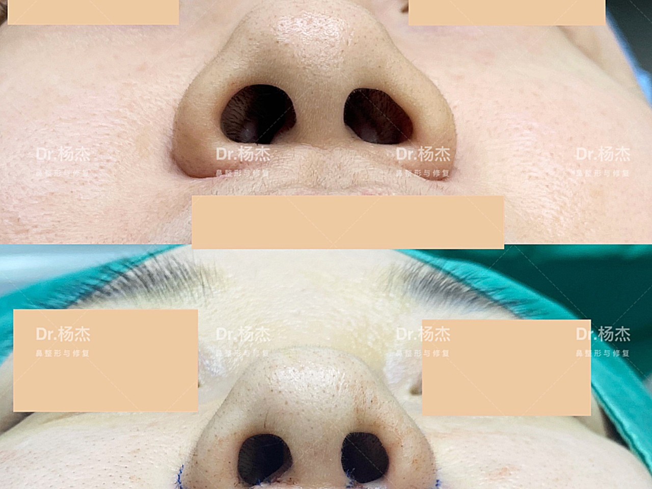 鼻翼内切 外切#缩鼻翼