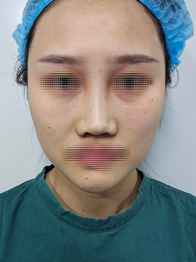 鞍鼻2.玻尿酸,线雕隆鼻术后3.鼻翼悬_圈子-新氧美容整形