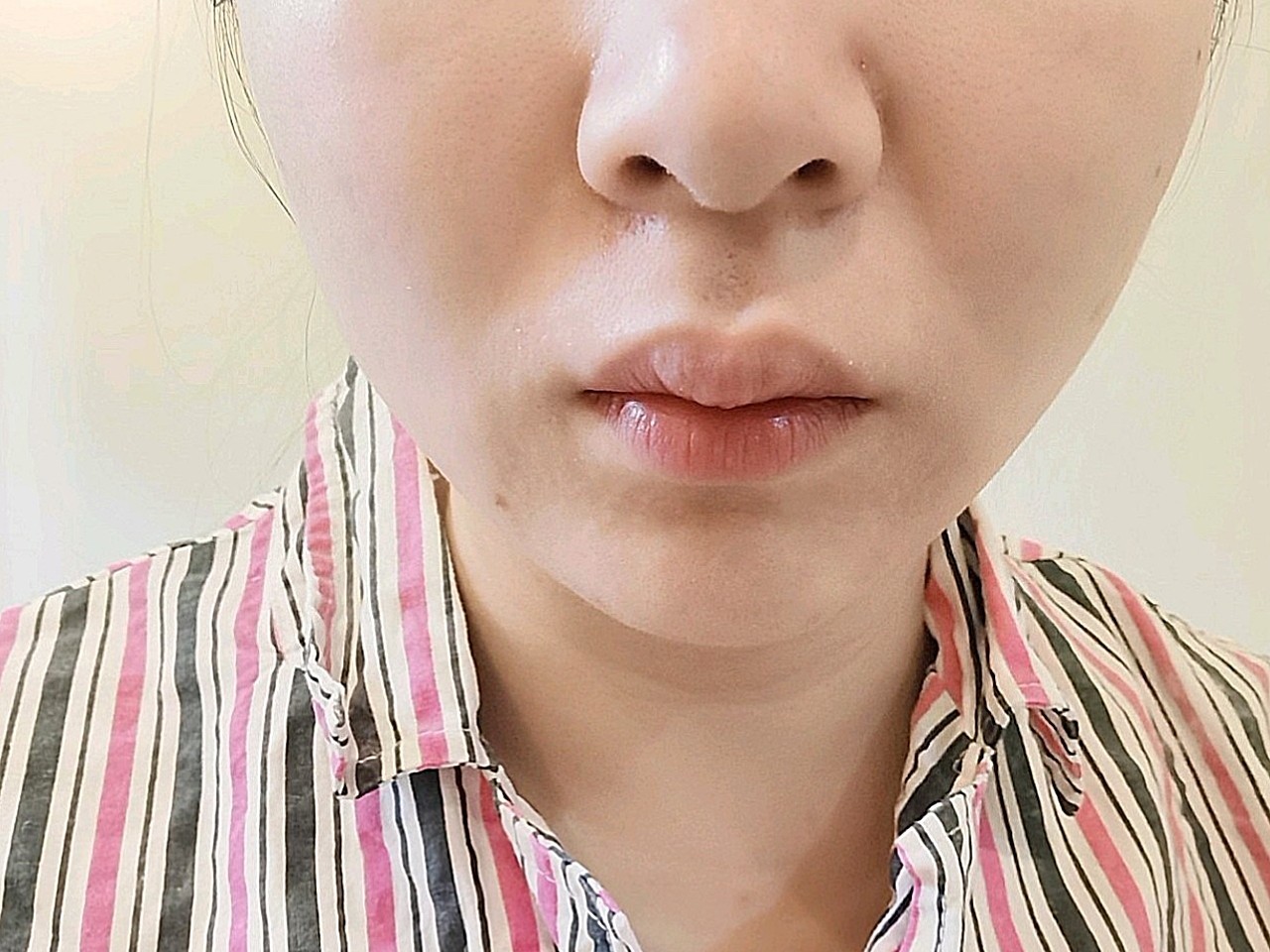 上唇不对称且有增生,看上去很厚,之前一直有想法要改_圈子-新氧美容