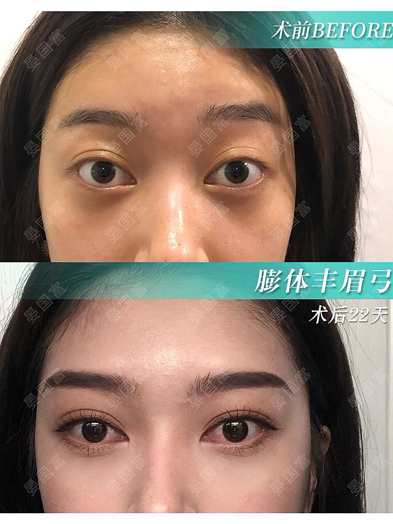 诊断97姑娘术前眉弓无基础,侧面眼球有点突出,轻_圈子-新氧美容整形