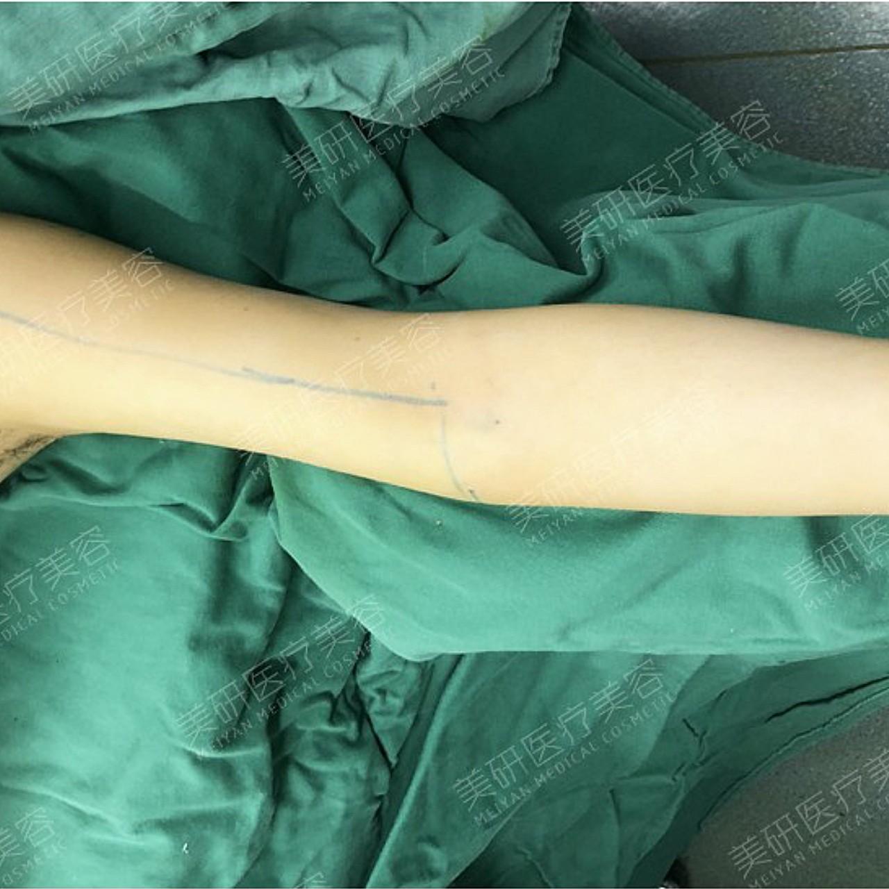 术前诊断术前手臂皮下脂肪堆积过于肥厚,且处于相对松_圈子-新氧美容
