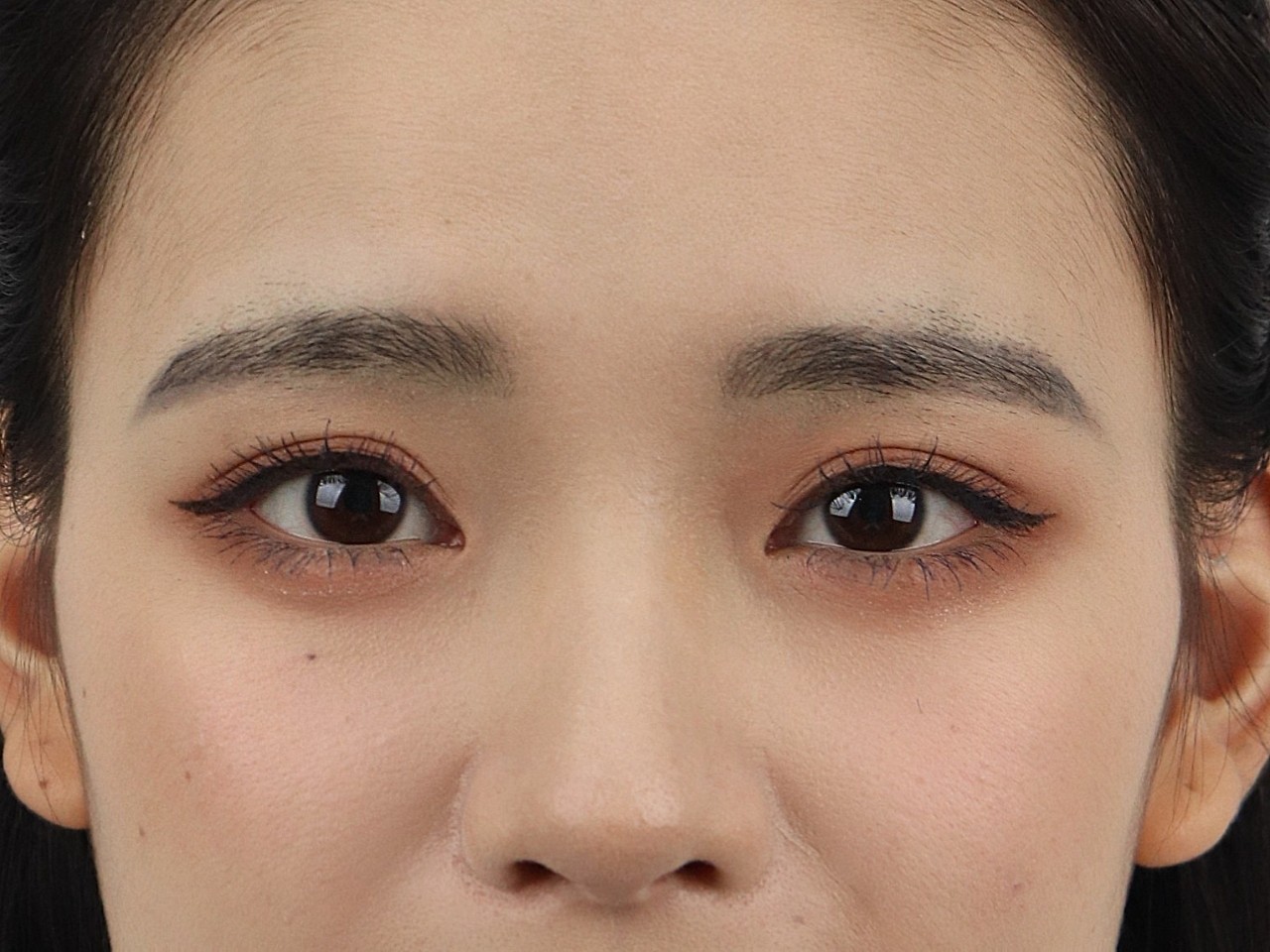 术前诊断术前情况:双眼呈单睑,双眼裂大小基本对称