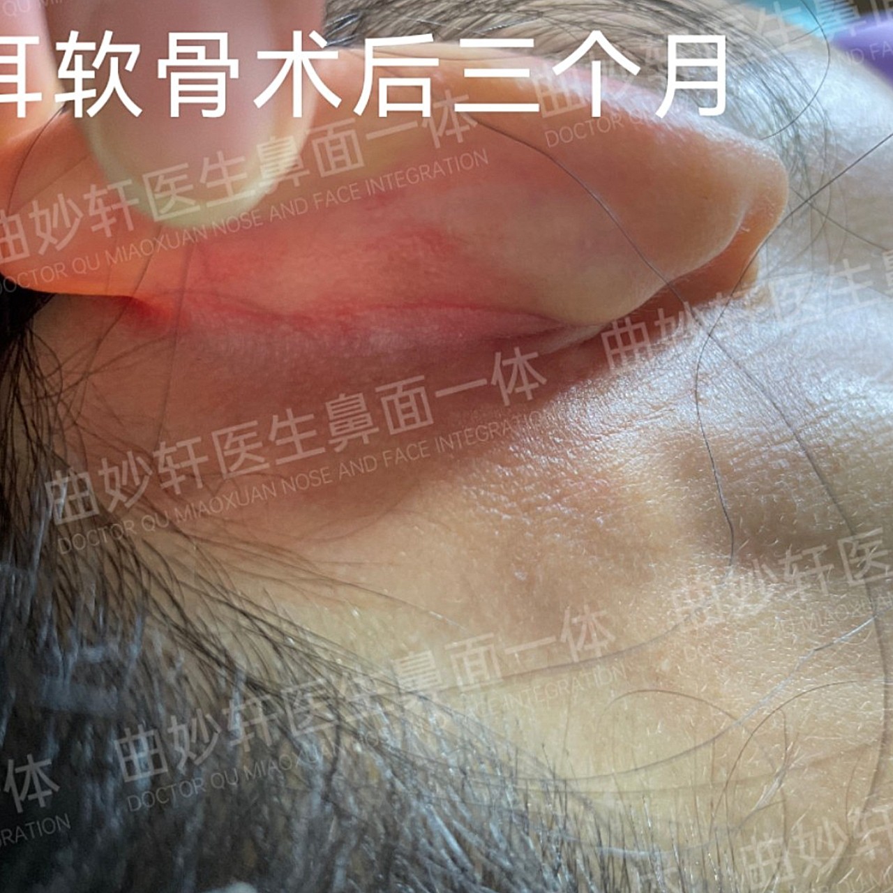 我个人取耳软骨是在耳后取的