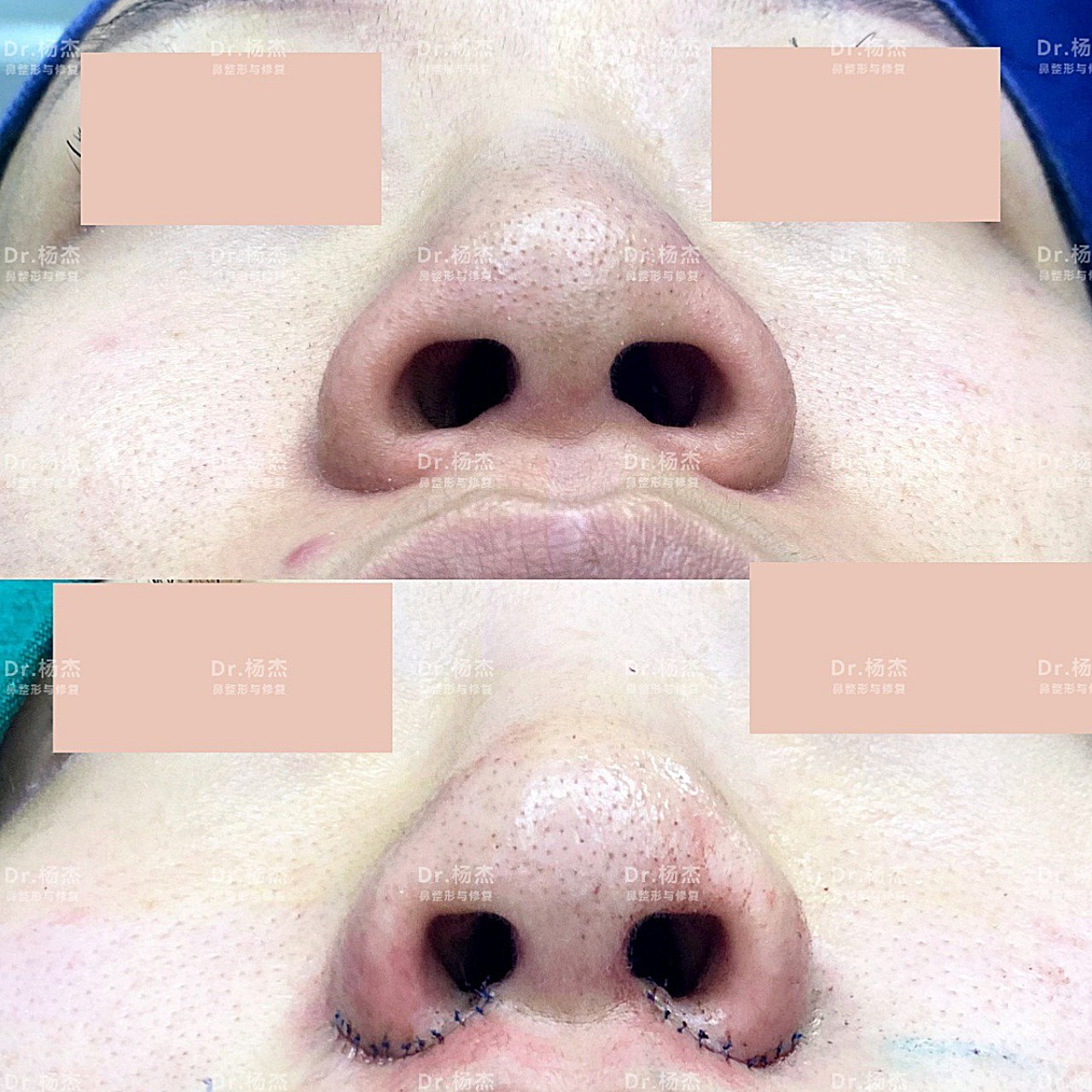 [cp]【内外联合鼻翼缩小鼻槛上提】术前鼻翼宽度4_圈子-新氧美容整形