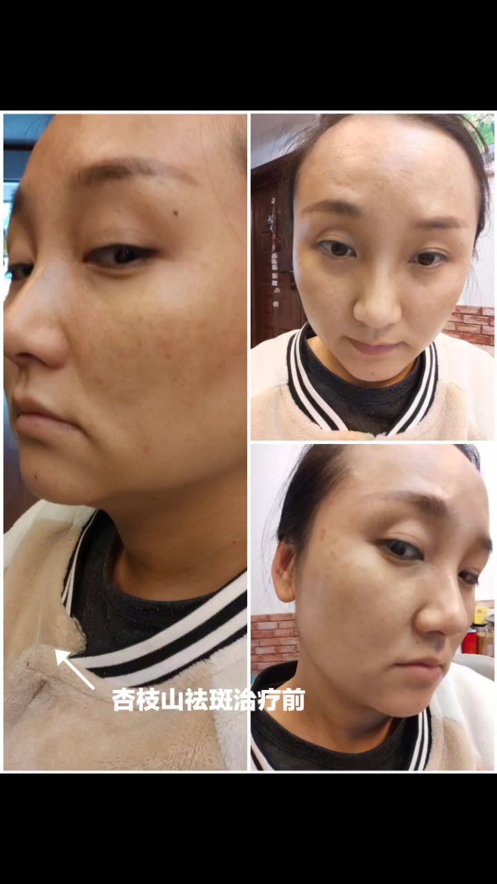 斑友们集合了,新鲜出炉的杏枝山活性祛斑治疗半个月效_圈子-新氧美容