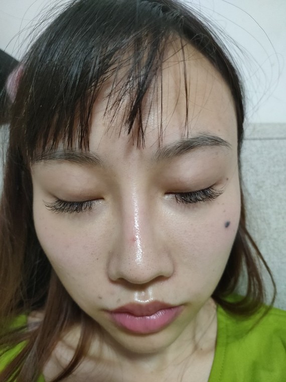 这个鼻子是不是非常失败,通天,鼻假体现出原形,鼻子_圈子-新氧美容