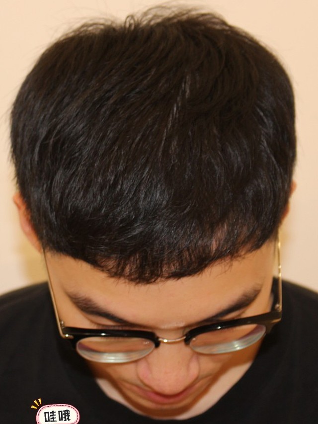 我是天生前额发量稀疏,两边额角秃,让我整个人看起来_圈子-新氧美容