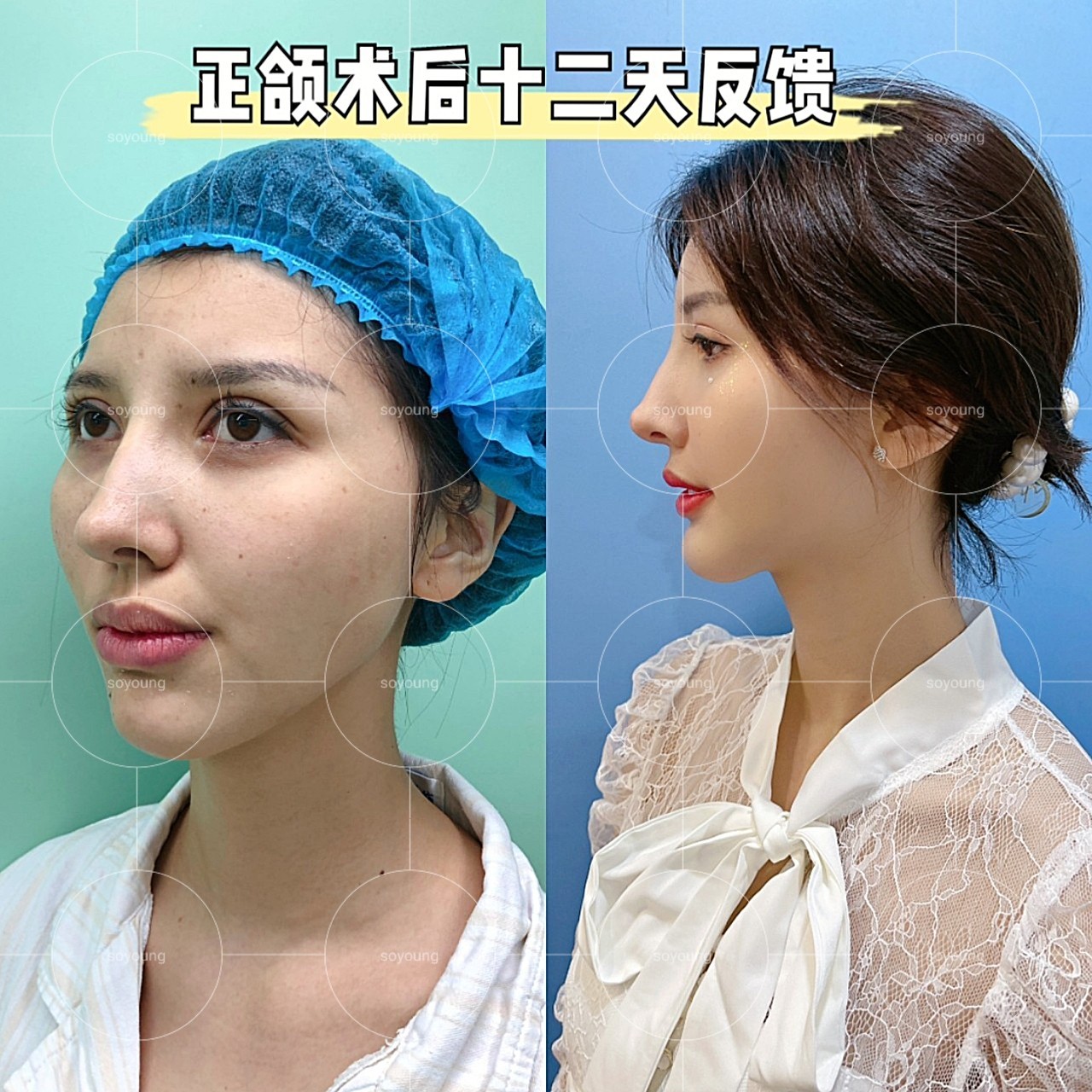 颌术后12天拆线反馈对比矫正脸型骨性缺陷:凸嘴正_圈子-新氧美容整形