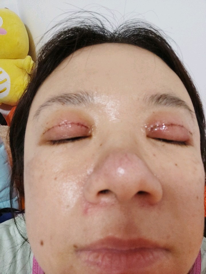 双眼皮手术肿胀