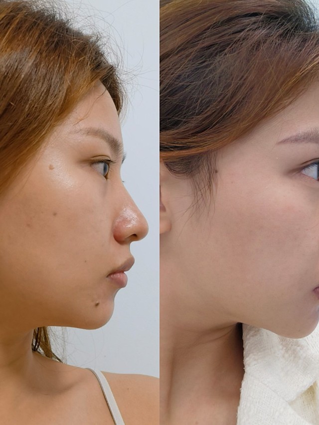 今天是我做超声炮(下颌缘)一周了!