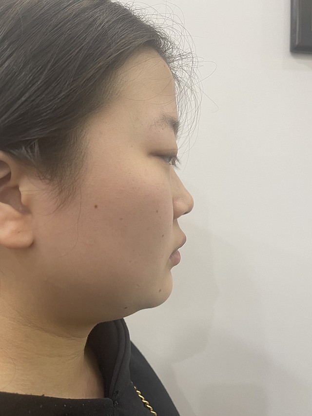 虽然说我是有双眼皮的,但是是个内双,睁眼的时候上