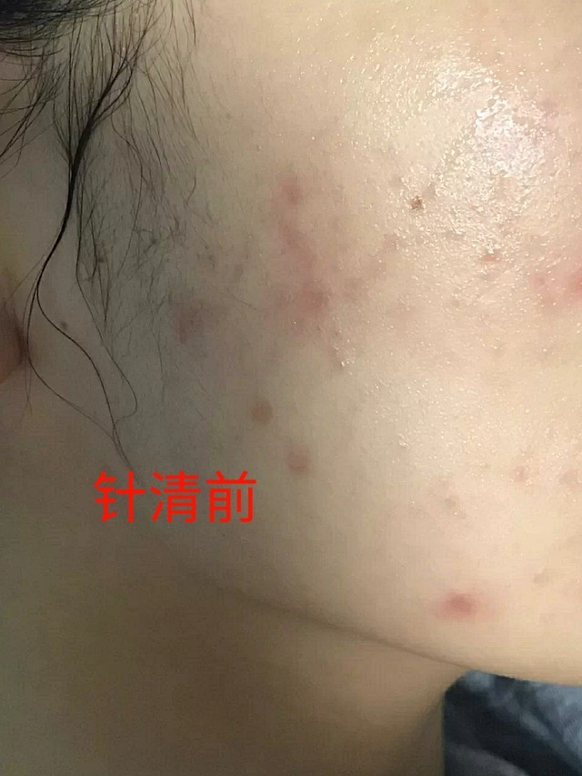 做完针清恢复后痘痘真的少了很多,到时候做完针清后又_圈子-新氧美容