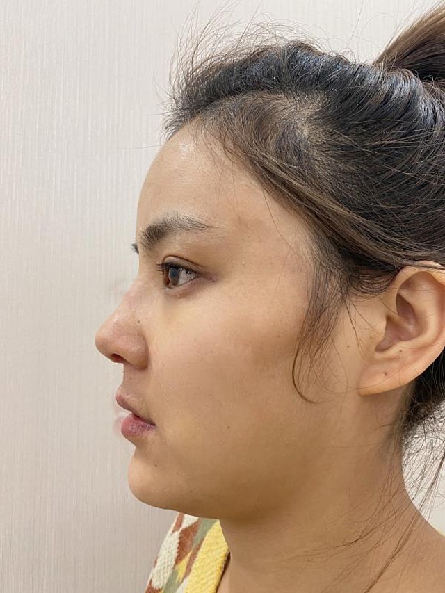 短鼻延长七天的效果挺满意的