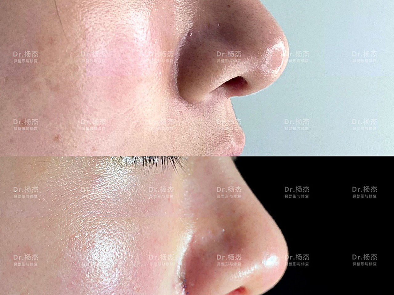 鼻翼内外缩小鼻槛鼻翼脚上提