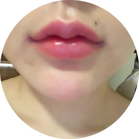 手术项目上唇m唇下唇pp唇嘴角上扬78