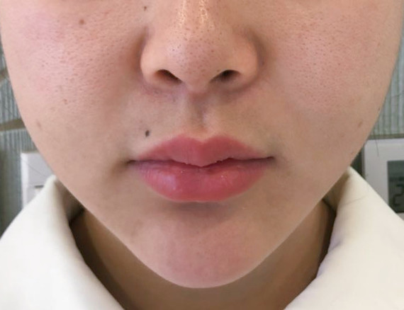 手术项目上唇m唇下唇pp唇嘴角上扬78