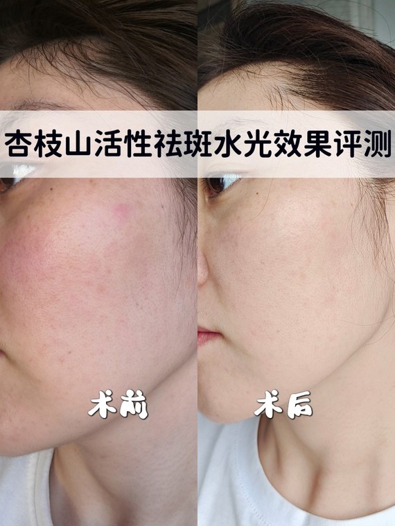 杏枝山活性祛斑水光效果评测