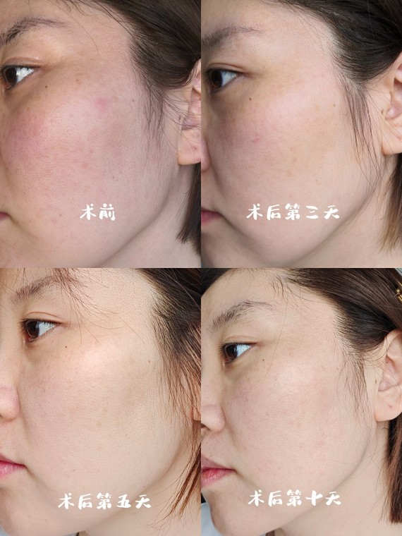 杏枝山活性祛斑水光效果评测