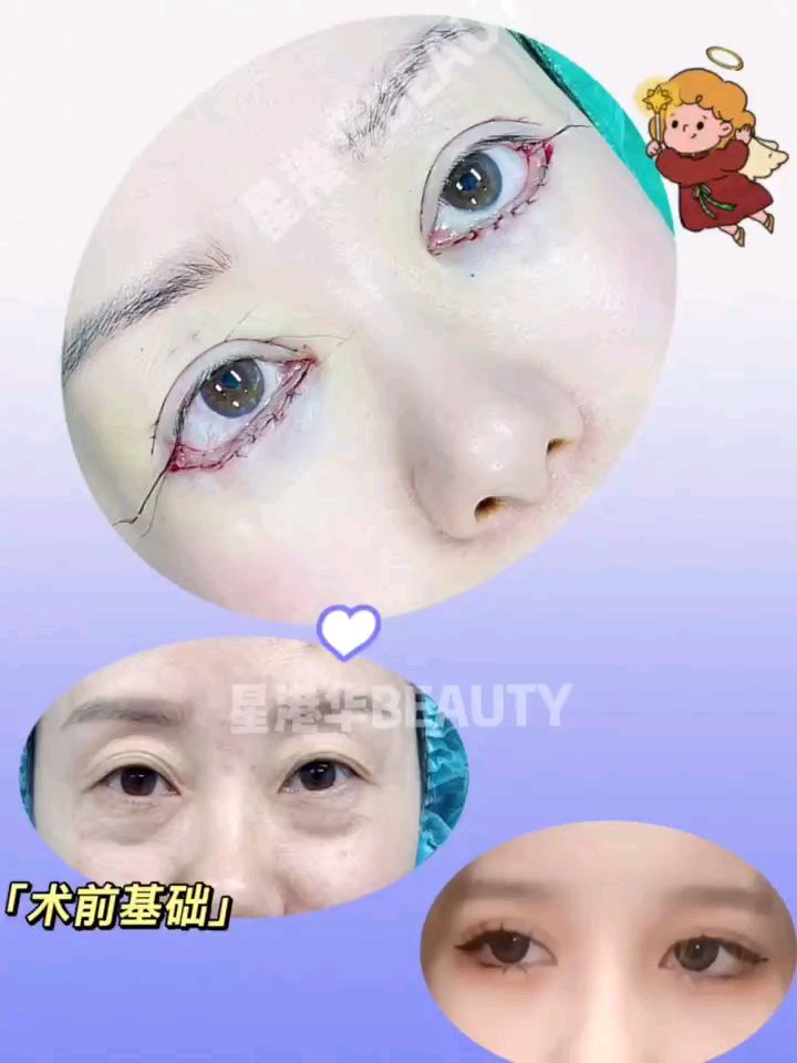 外切眼袋术后即刻对比9893改善上眼皮松弛,告_圈子-新氧美容整形
