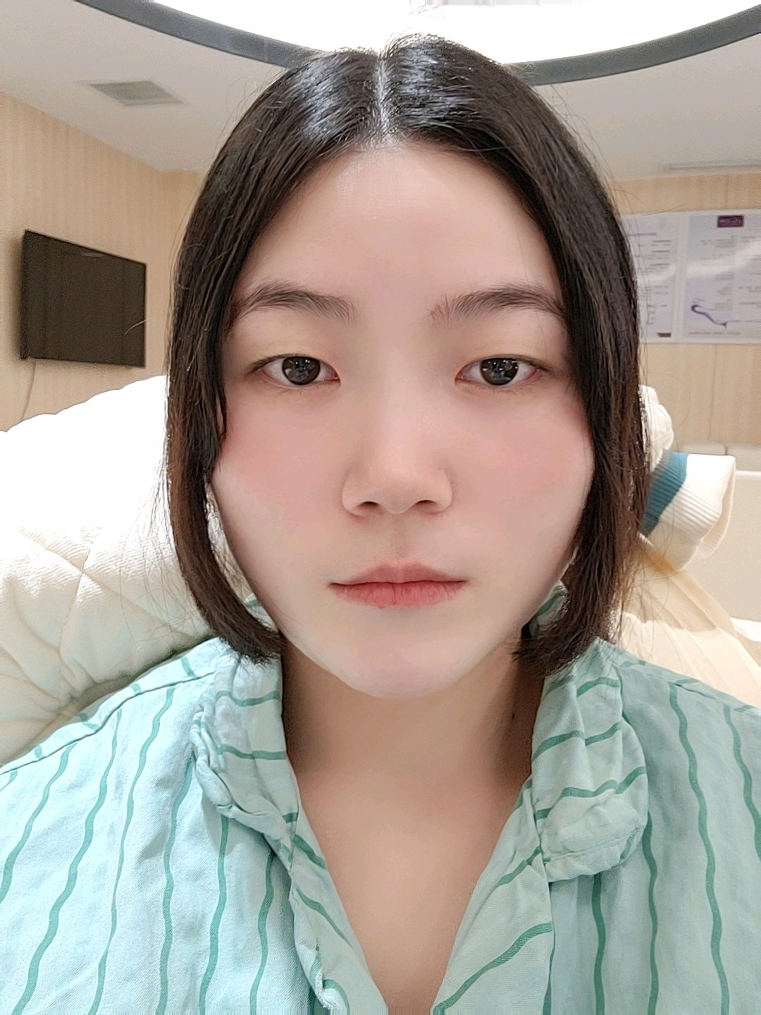 双眼皮割的很长眼尾还有鼓包一笑就像鱼尾纹