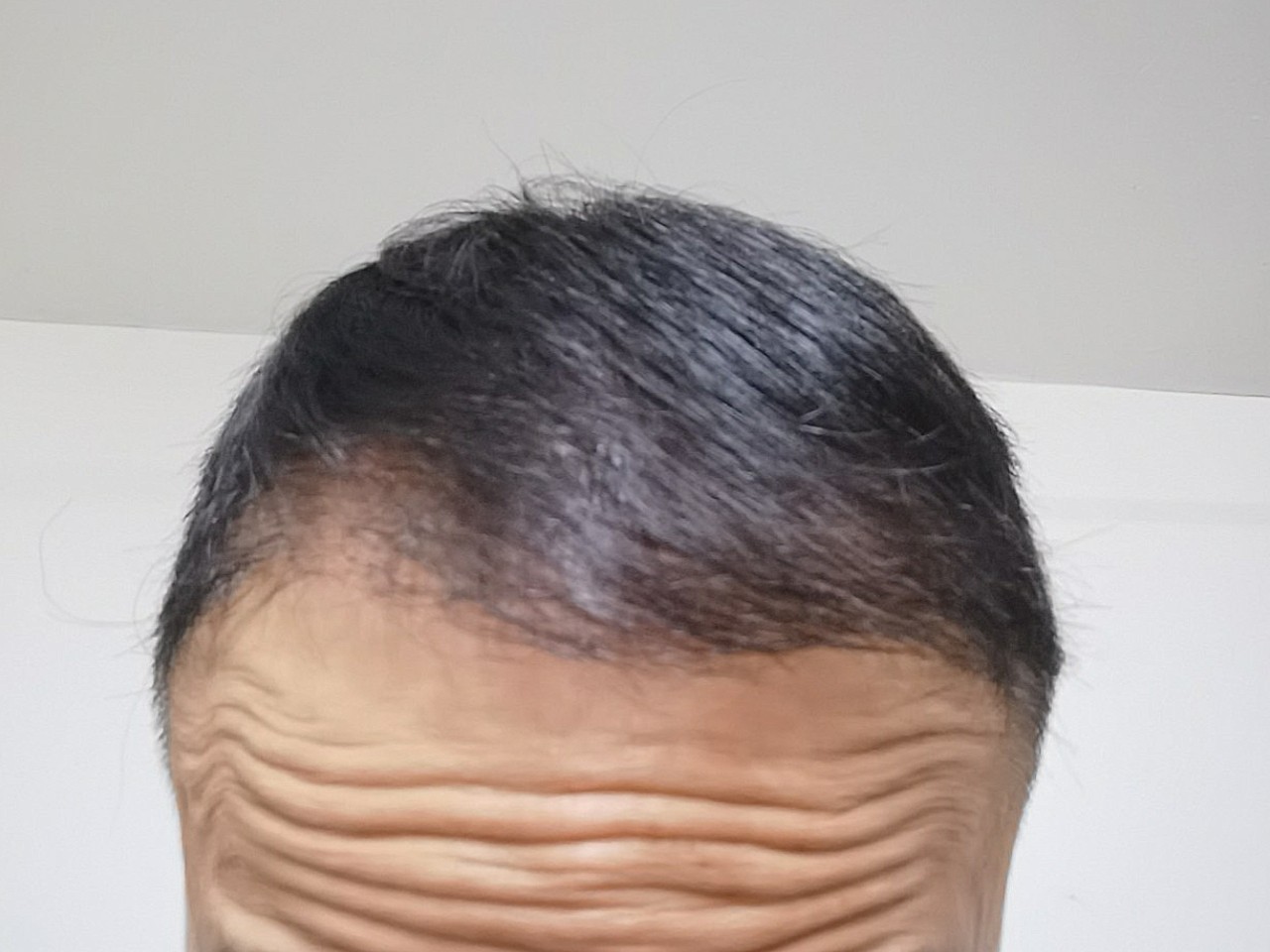手术后半年了头发还是很稀疏很期待一年后的变化