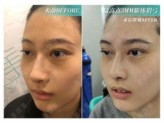 项目 膨体垫眉弓高度 5mm材料 凤凰膨体 圈子 新氧美容整形