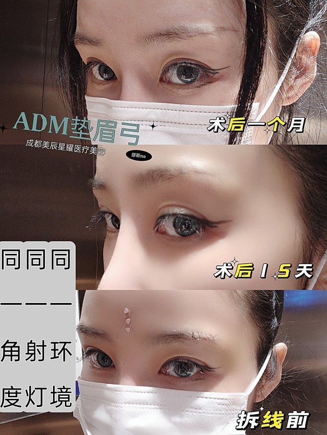 92adm垫眉弓——术前沟通重要性素颜终于满一个月了_圈子-新氧美容