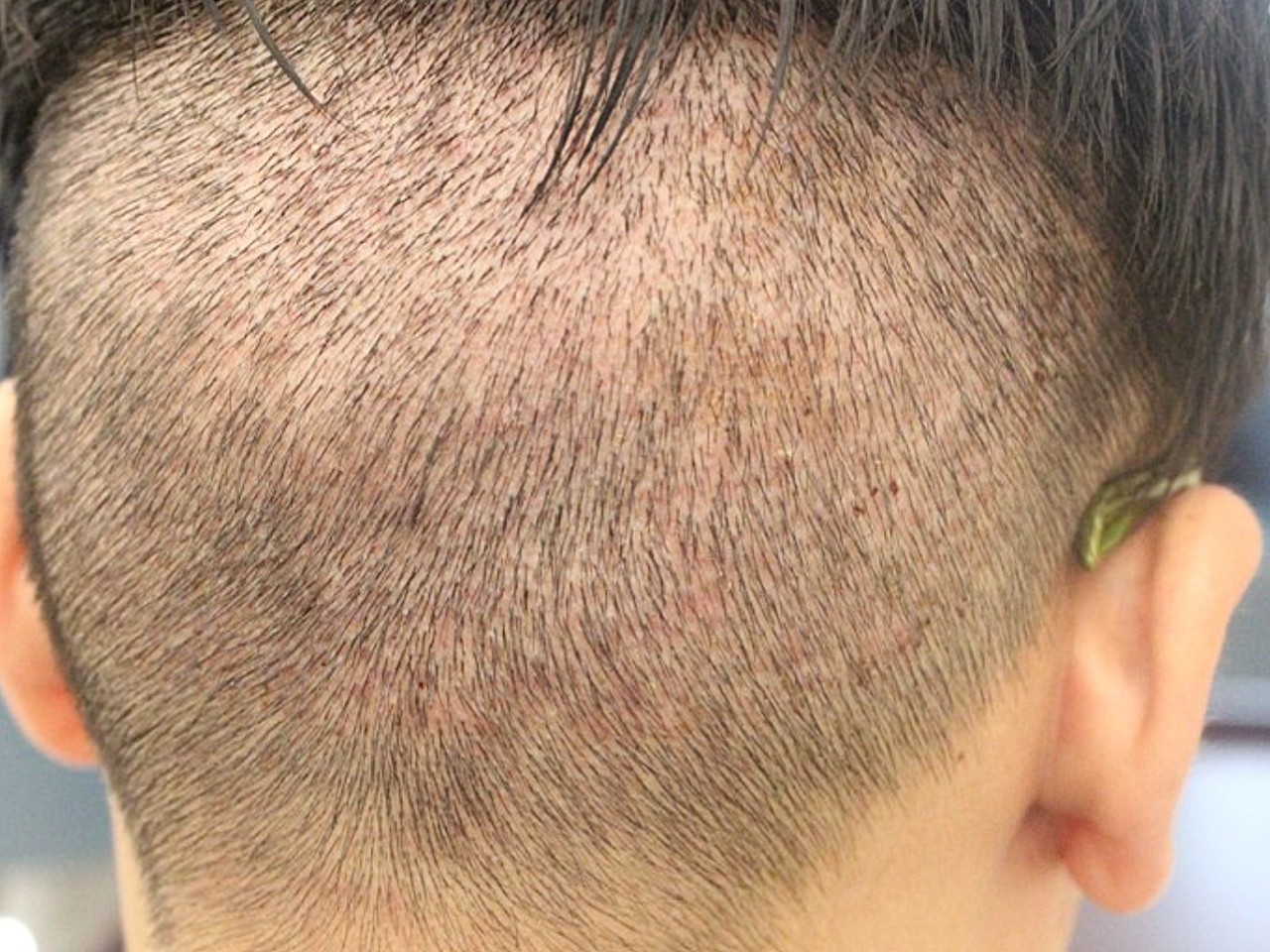 发个后枕部情况吧,估计都很关心后面取完秃不秃~只要_圈子-新氧美容