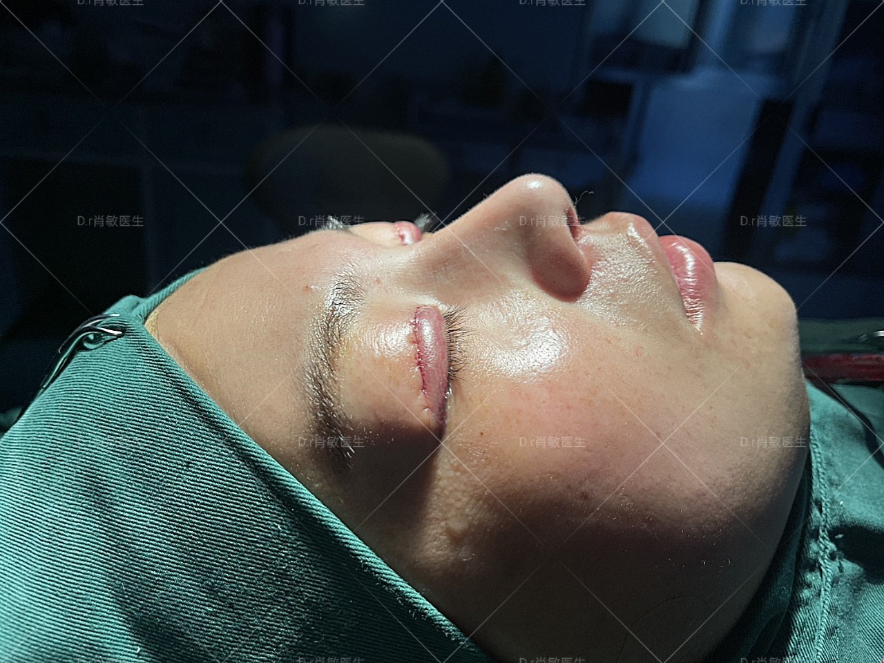 术前诊断先天性低鼻,鼻中隔偏曲,双侧鼻孔不对称,鼻_圈子-新氧美容