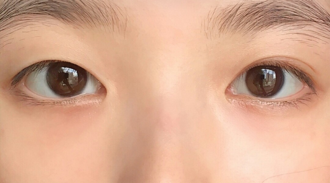 从照片可以看出,我的眼睛一单一内双,大小不对称,眼_圈子-新氧美容