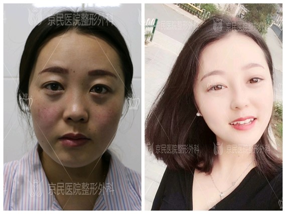 鼻部多项】#案例分享# 相对欧美人来说,亚洲人的鼻子鼻梁较低鼻尖较圆