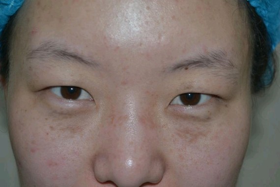 近期很多求美者私信咨询一些关于眼部手术的问题,今天就给大家科普一